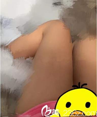 吸脂瘦大腿术前 吸脂瘦大腿术前