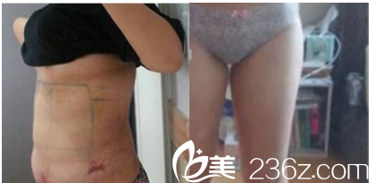 北京丹熙腰腹部和大腿吸脂案例第七天