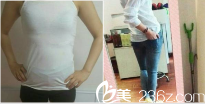 数月前我在北京丹熙找魏洁做了腰腹部和大腿吸脂后效果挺满意