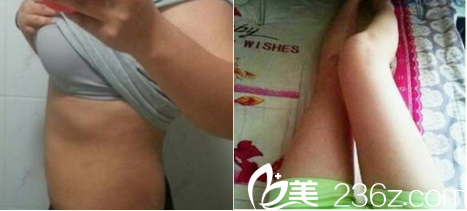 北京丹熙腰腹部和大腿吸脂2月效果