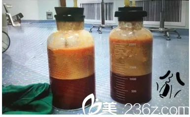 吸脂手术过程中 吸脂手术过程中