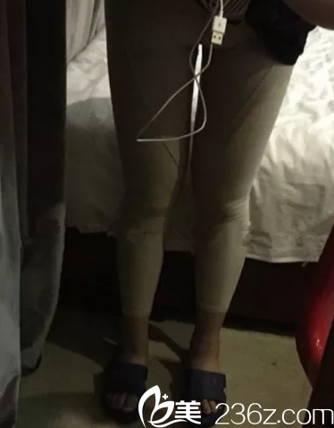 术后一周大腿吸脂恢复 术后一周大腿吸脂恢复