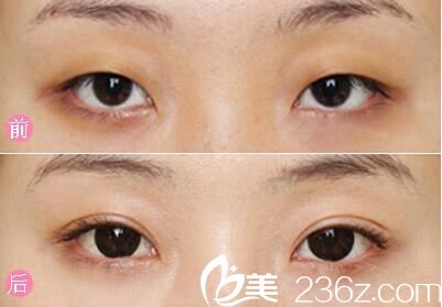 双眼皮整形前后对比
