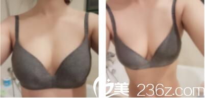 上海灵之水医疗美容门诊部王春明自体脂肪隆胸真人案例术后十五天