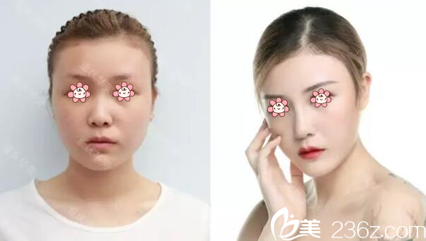 杨健达拉斯隆鼻案例