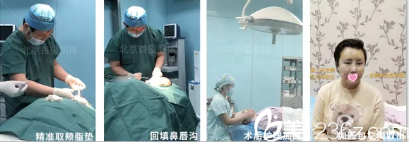 北京首玺丽格去颊脂垫案例手术照