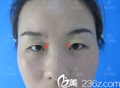 术前照片 术前照片