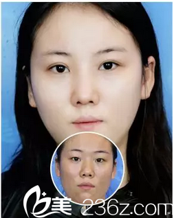 深圳非凡整形医院丁峰双眼皮案例对比图 深圳非凡整形医院丁峰双眼皮案例对比图