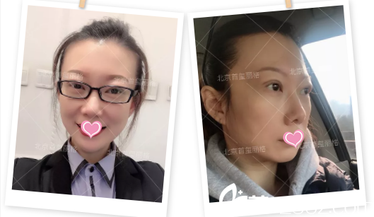北京首玺丽格刘志华双眼皮修复外路法祛眼袋案例术后2周
