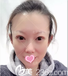 刘志华双眼皮修复祛眼袋案例术后1月效果