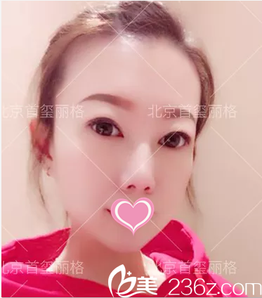北京首玺丽格刘志华双眼皮修复祛眼袋真人案例