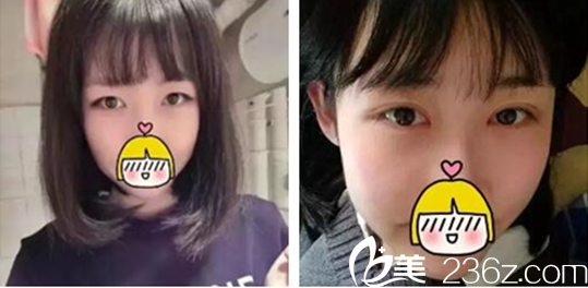 刘圆医师美眼案例