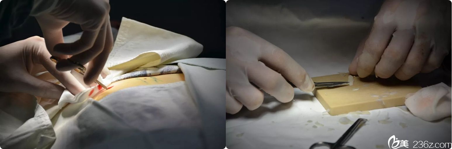 肋软骨的取出和雕刻过程 肋软骨的取出和雕刻过程