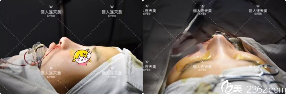 鼻综合术后即刻效果展示 鼻综合术后即刻效果展示