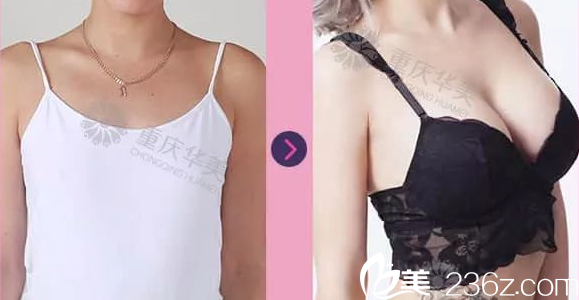 杨丽萍医师丰胸案例