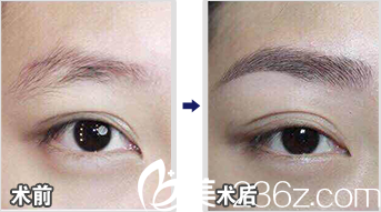 北京米兰柏羽丽都马建民眉毛种植效果 北京米兰柏羽丽都马建民眉毛种植效果