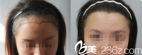 北京米兰柏羽丽都美人尖种植效果 北京米兰柏羽丽都美人尖种植效果