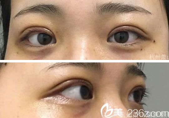 看我在杭州黛雅做的全切双眼皮手术7天后恢复效果自然吗？