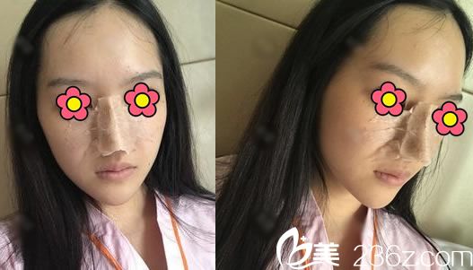做完肋软骨隆鼻手术当天照片 做完肋软骨隆鼻手术当天照片