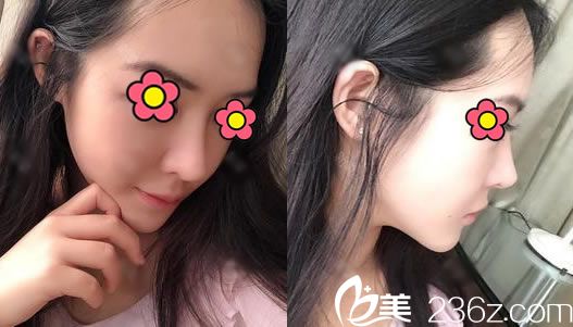 找杭州瑞丽做隆鼻20天后 找杭州瑞丽做隆鼻20天后