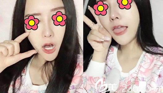 肋软骨隆鼻手术60天恢复<span style= 肋软骨隆鼻手术60天恢复<span style=