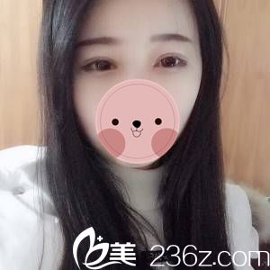 公开我在做的切开双眼皮术后半个月恢复全过程日志 包你看了也会心动