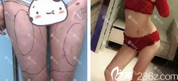 张梅医师大腿吸脂案例