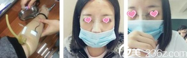 赣州韩美整形医院隆鼻手术案例 赣州韩美整形医院隆鼻手术案例