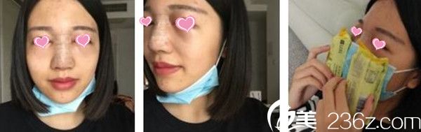 谢靓花隆鼻手术案例 谢靓花隆鼻手术案例