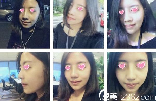 假体隆鼻后恢复效果 假体隆鼻后恢复效果