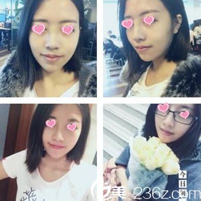 隆鼻术后12天 隆鼻术后12天