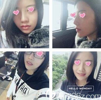 假体隆鼻后一个月恢复效果 假体隆鼻后一个月恢复效果