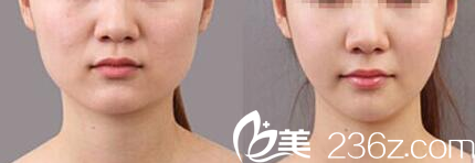 北京米兰柏羽丽都<!--<i data=20240703-sp></i>-->注射瘦脸案例 北京米兰柏羽丽都<!--<i data=20240703-sp></i>-->注射瘦脸案例