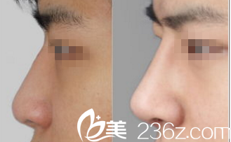 北京米兰柏羽丽都<!--<i data=20240703-sp></i>-->注射隆鼻案例 北京米兰柏羽丽都<!--<i data=20240703-sp></i>-->注射隆鼻案例