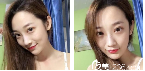 深圳贝漾美天曹思佳双眼皮术后六天效果图