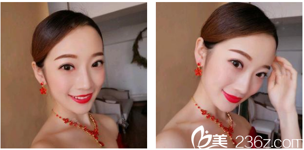 深圳贝漾美天曹思佳双眼皮案例术后两个月图片