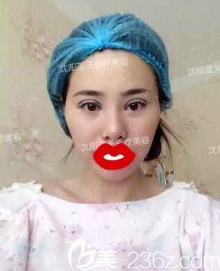 全切双眼皮手术当天