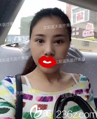 割双眼皮术后拆线