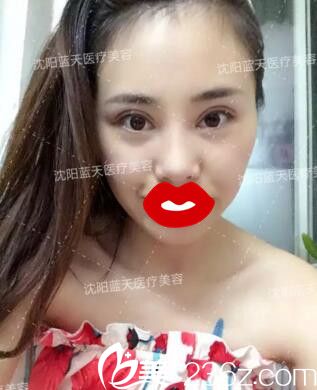 割双眼皮术后第十天