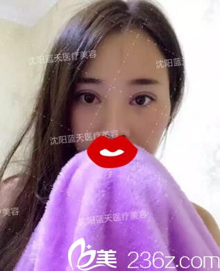 亲身经历：分享沈阳蓝天于国艳给我做的全切双眼皮术后半个月恢复效果图