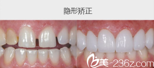 吴承琼主任隐形矫正案例 吴承琼主任隐形矫正案例