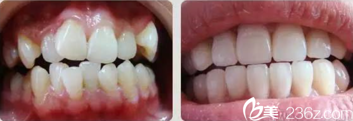 苗智许医师口腔正畸案例 苗智许医师口腔正畸案例