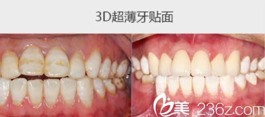 丁爱师牙贴面案例 丁爱师牙贴面案例
