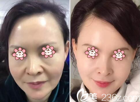 杜航航面部年轻化案例 杜航航面部年轻化案例