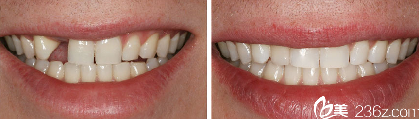 遇海波种植牙案例