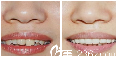遇海波冷光美白牙齿案例