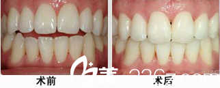 遇海波牙齿矫正案例