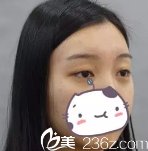 我在大同美神整形医院做双眼皮之前的照片 我在大同美神整形医院做双眼皮之前的照片