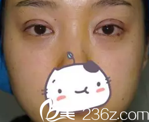 我在大同美神做全切双眼皮术后第3天的照片 我在大同美神做全切双眼皮术后第3天的照片