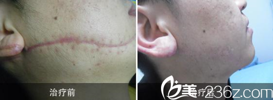 韦志远医师疤痕修复案例 韦志远医师疤痕修复案例
